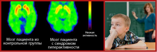 Синдром дефицита внимания и гиперактивности.